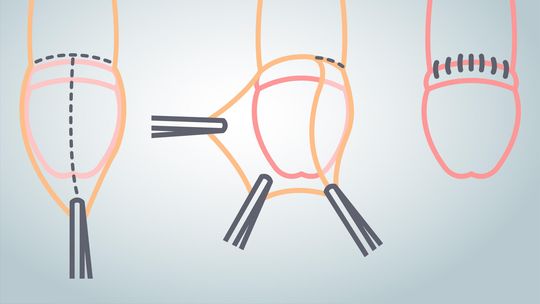 Esquema de la circuncisión. Esquema de la circuncisión.