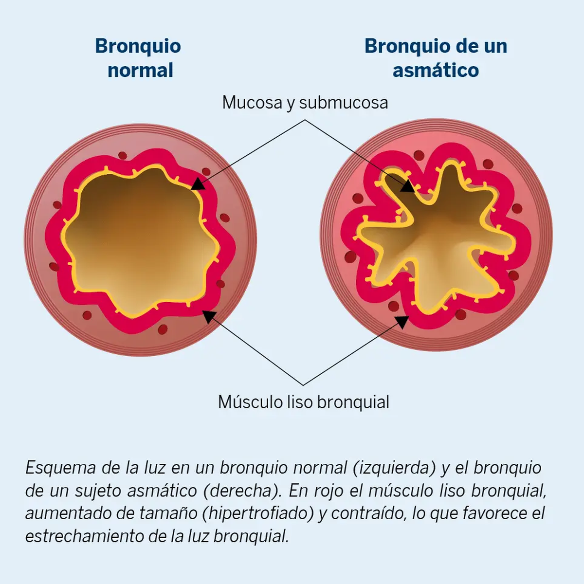 El asma provoca el estrechamiento de las vías respiratorias, lo que las llena de mucosa y dificulta el ingreso del aire y la respiración. En algunos pacientes, los síntomas son leves y en otros son más graves y afectan su vida cotidiana. El asma provoca el estrechamiento de las vías respiratorias, lo que las llena de mucosa y dificulta el ingreso del aire y la respiración. En algunos pacientes, los síntomas son leves y en otros son más graves y afectan su vida cotidiana.