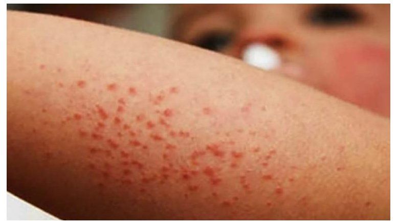 Sarampión: la re-emergencia mundial y la situación en Brasil generan un serio aumento del riesgo en Argentina