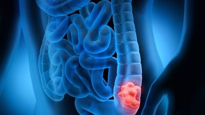 Cáncer de colon: Los casos tomados a tiempo se pueden curar 
