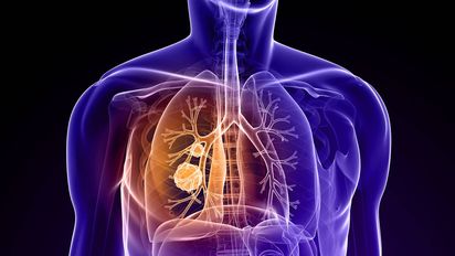 Atentos a este síntoma doloroso e inesperado de cáncer de pulmón