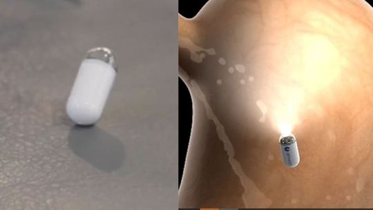Ciencia: China crea cápsula con IA para exámenes estomacales que lo cambia todo.