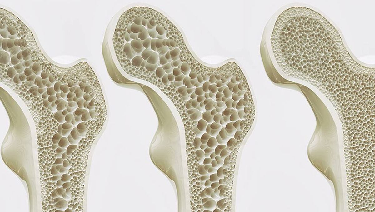 ¿Qué aumenta el riesgo de osteoporosis?