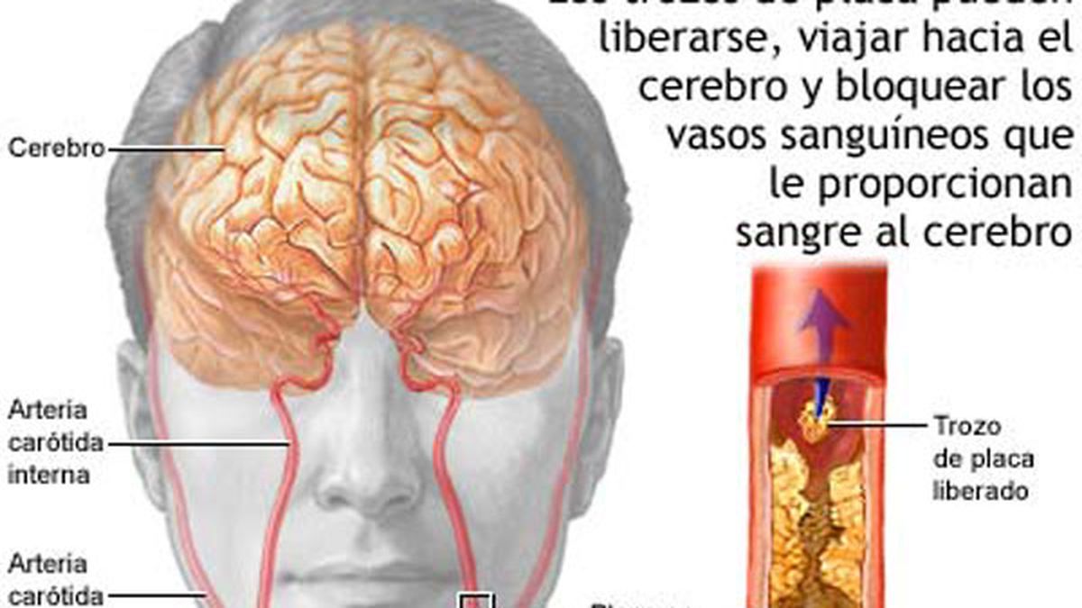 Причины сужения головного мозга. Инсульт сонной артерии. Эмболия мозговых артерий. Бляшки в сонной артерии шейного.