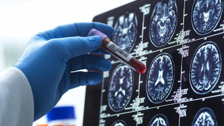 Nuevas esperanzas en la lucha contra el Alzheimer con exámenes de sangre