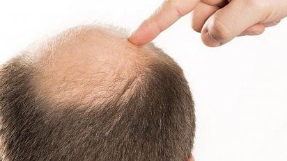 Si tu personalidad es esta, hay más riesgo de alopecia