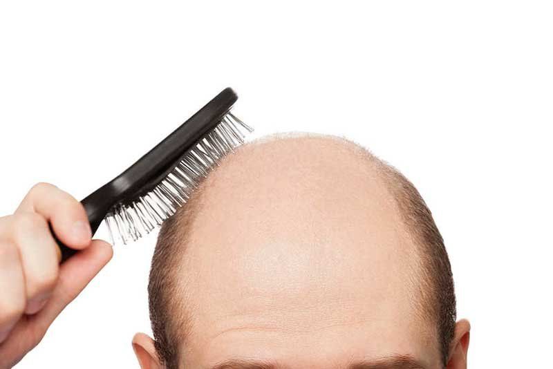 Los hombres más bajos podrían ser los más afectados y tener un riesgo mayor de calvicie prematura.