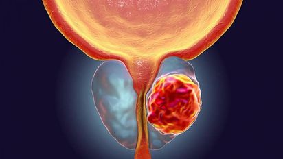 Sepa cómo prevenir el cáncer de próstata tras conocer que presentador de ESPN lo sufre
