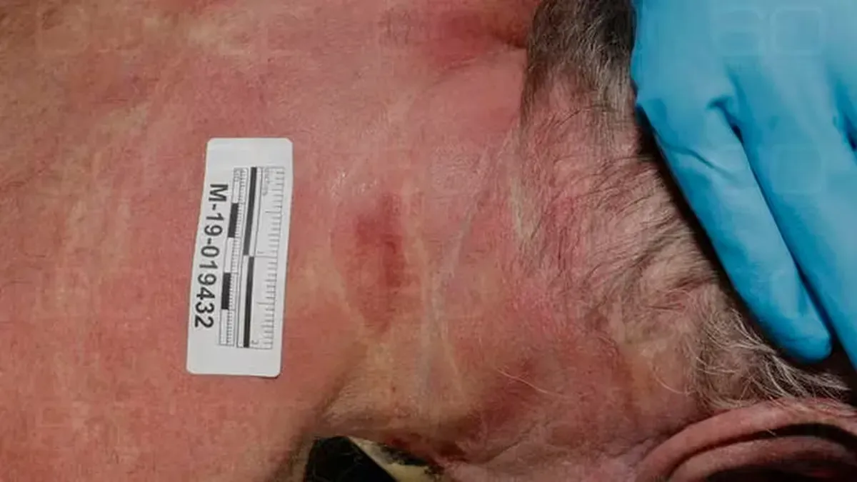 Marcas en la parte anterior del cuello de Jeffrey Epstein (Gentileza 60 Minutes/CBS) Marcas en la parte anterior del cuello de Jeffrey Epstein (Gentileza 60 Minutes/CBS)