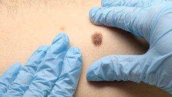 Día Mundial del Melanoma: Claves de una especialista en cáncer de piel