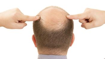 Alopecia: Este alimento está afectando su caída de pelo. Alopecia: Este alimento está afectando su caída de pelo.
