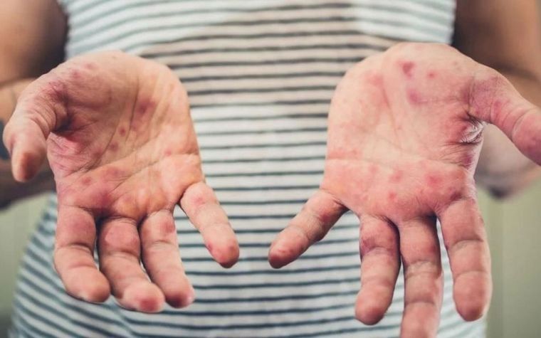 Alerta por casos de sarampión. Alerta por casos de sarampión.