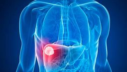 La bebida que todos conocen y se relaciona con cáncer de hígado.