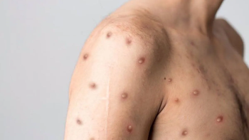 Alerta mundial por el brote de mpox. Alerta mundial por el brote de mpox.