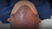 El modelo de Turquía que transformó la industria del cabello. El modelo de Turquía que transformó la industria del cabello.