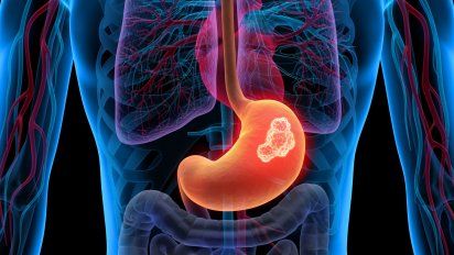 Si haces esto al comer, tienes mayor riesgo de cáncer de estómago