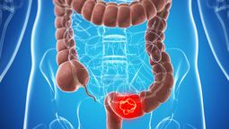 El cáncer de colon se ha convertido en el más mortífero entre los jóvenes.