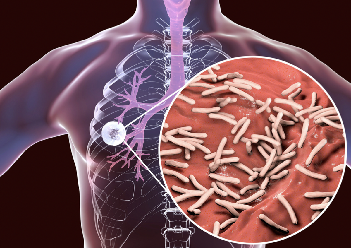 Si bien puede parecer similar a la neumonía, la tuberculosis tiene algunas diferencias importantes y es vital no confundirla. Además de tener un origen estrictamente bacteriano, se cobra más vidas que el COVID-19. Si bien puede parecer similar a la neumonía, la tuberculosis tiene algunas diferencias importantes y es vital no confundirla. Además de tener un origen estrictamente bacteriano, se cobra más vidas que el COVID-19. 