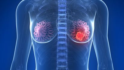 Estas 5 cosas te acercan al cáncer de mama sin darte cuenta