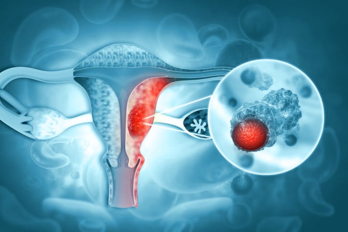 Científicos de Mayo Clinic desarrollan pruebas caseras para cáncer de  endometrio y ovario con hisopo