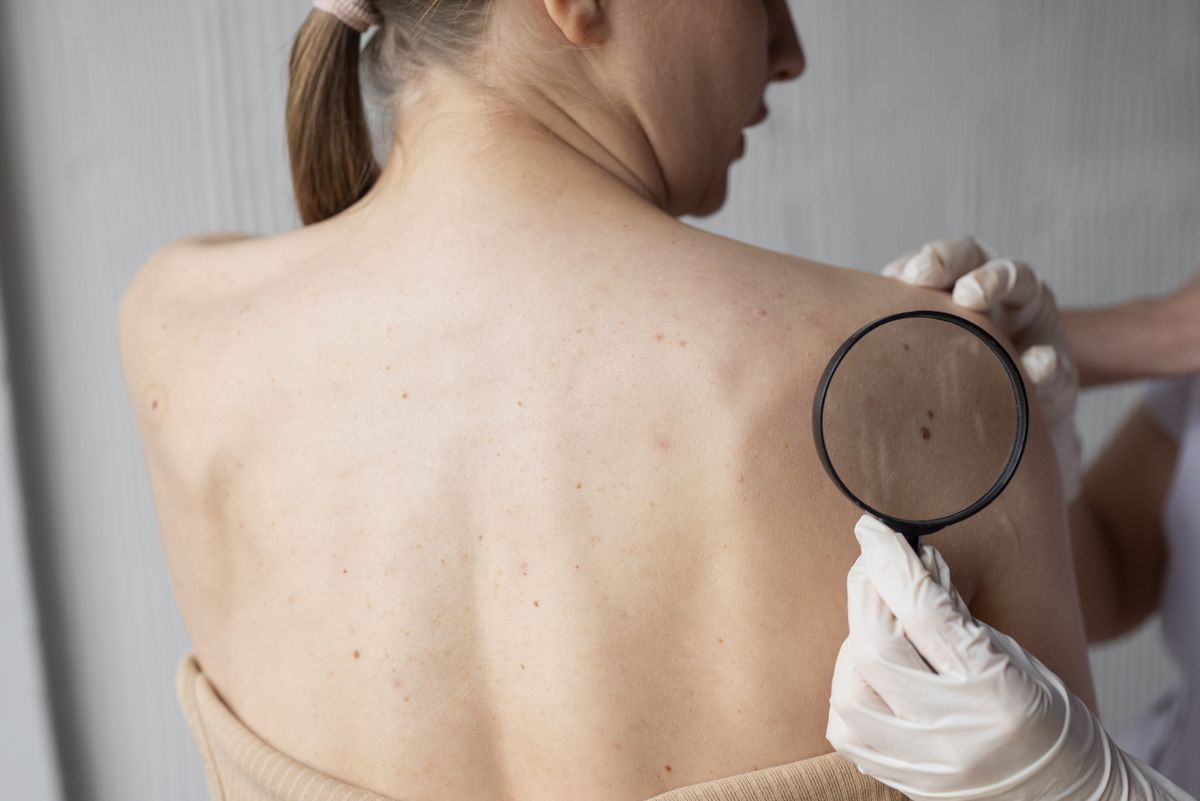 Es posible prevenir el cáncer de piel. Es posible prevenir el cáncer de piel.