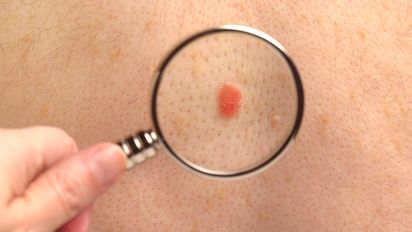 Vacuna argentina contra melanoma estaría disponible en breve