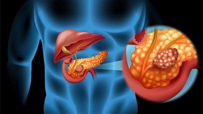 Cáncer de páncreas: El alimento que debes evitar totalmente