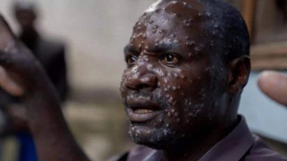 La OMS declaró la alerta mundial por el brote de viruela de mono en África