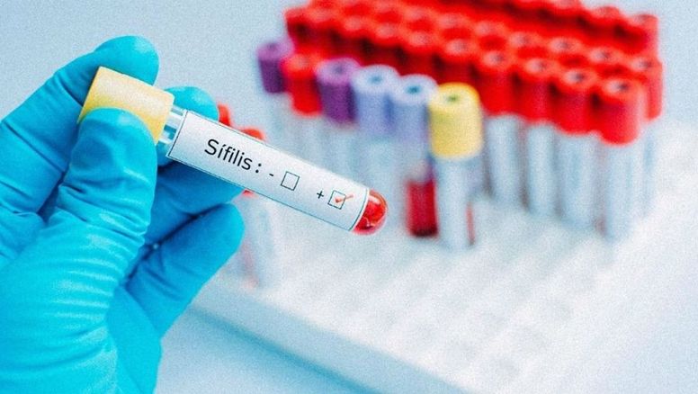 Sífilis en Argentina: Advertencia urgente de médicos y lo que piden que hagas de inmediato
