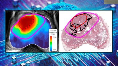 La Inteligencia Artificial supera a médicos en la detección del cáncer