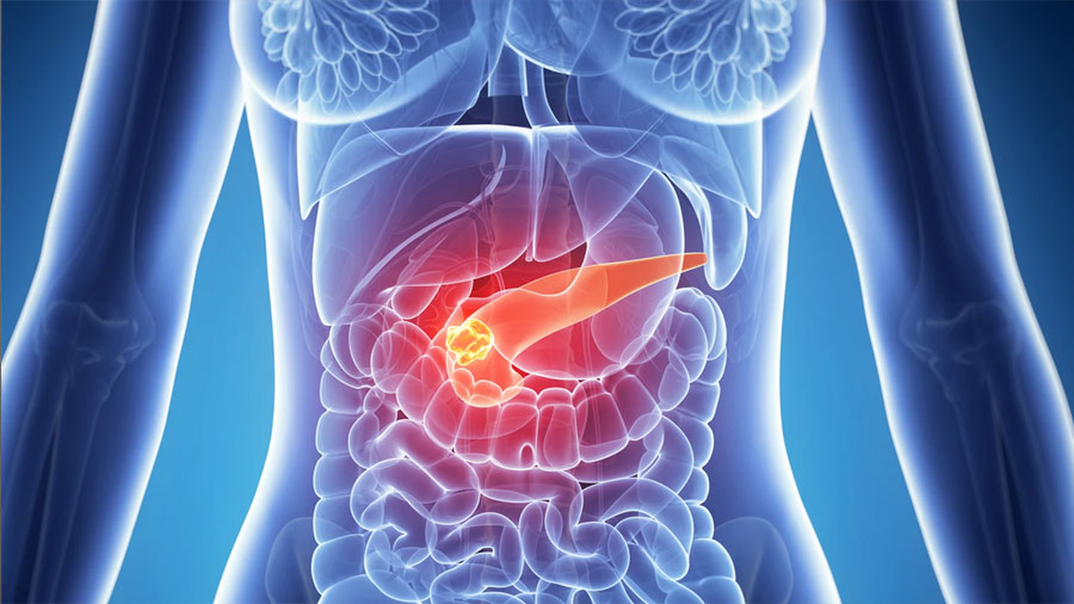 Cáncer de páncreas