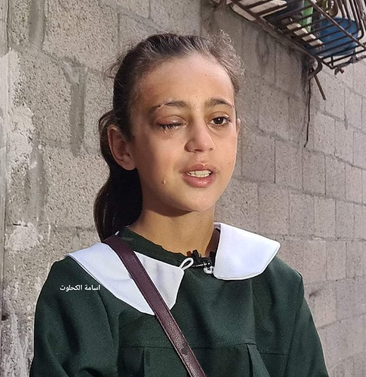 La estudiante palestina de 10 años Areej Asaliya, perdió su ojo derecho en un bombardeo israelí en Gaza. FUENTE: Palestina Broadcast.