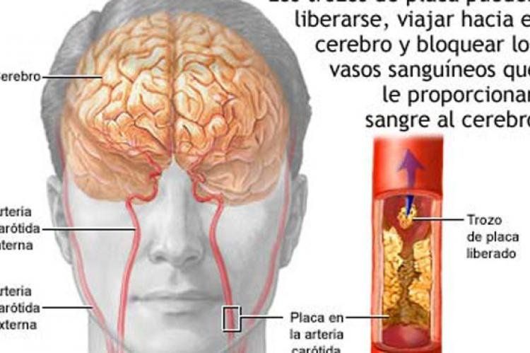 Atención Los Síntomas Silenciosos Del Derrame Cerebral