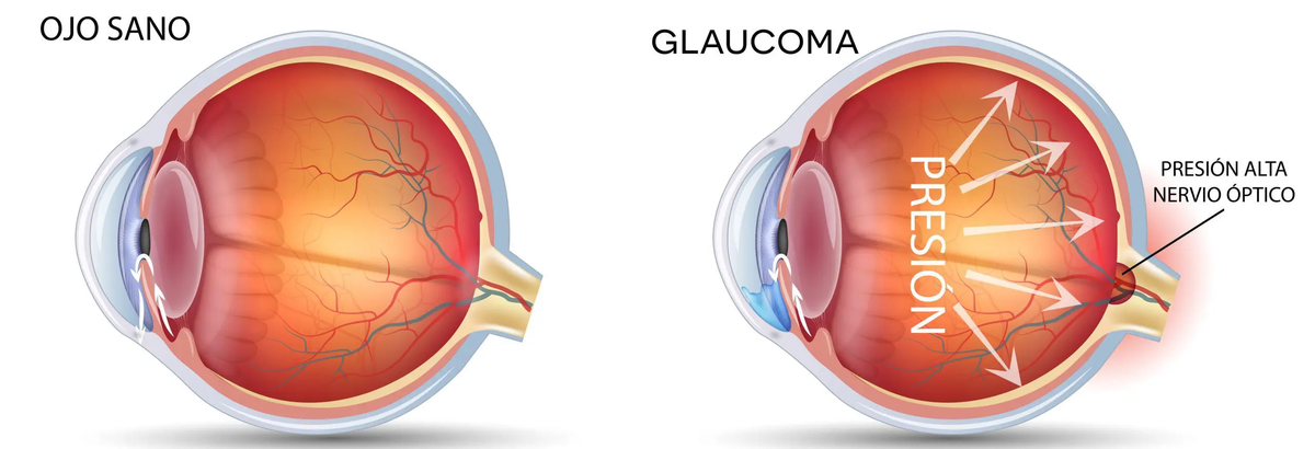 El glaucoma se produce por un exceso de presi&oacute;n en el nervio &oacute;ptico. Si bien sus s&iacute;ntomas no se notan al principio, es probable que la enfermedad est&eacute; avanzada cuando se comiencen a sentir.