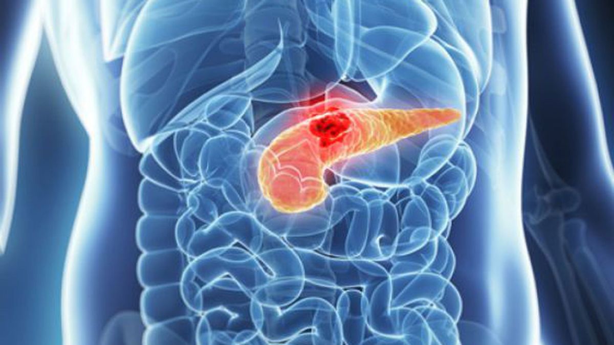 El cáncer de páncreas es uno de los más devastadores. El cáncer de páncreas es uno de los más devastadores.