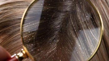 remedios naturales y baratos para la caspa remedios naturales y baratos para la caspa