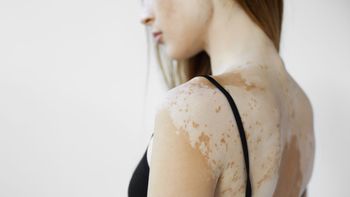 Día Mundial del Vitiligo: Qué es, a quién afecta y por qué aparece
