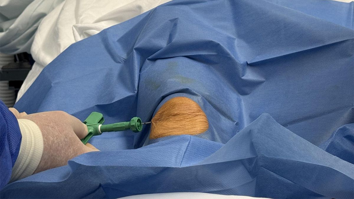 Los tratamientos con células madre sumado a la cirugía y la aplicación intraoperatoria apuntan a tratar las lesiones de rodilla. Los tratamientos con células madre sumado a la cirugía y la aplicación intraoperatoria apuntan a tratar las lesiones de rodilla.