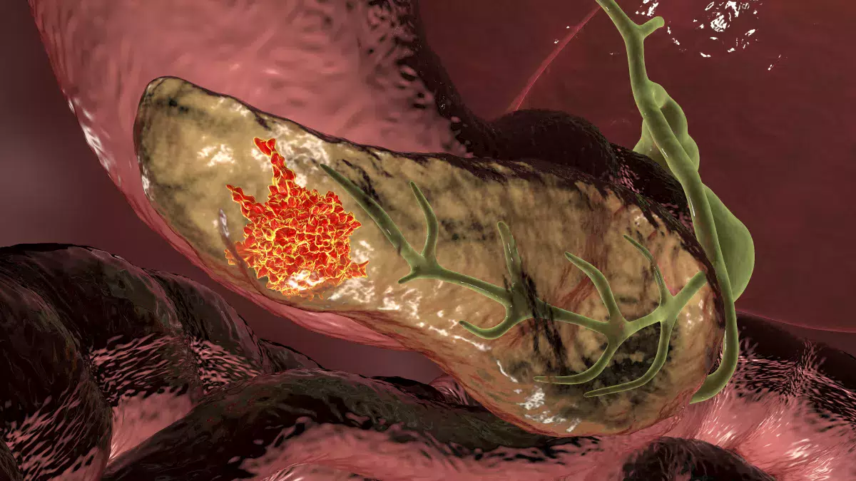 El cáncer de páncreas es uno de los más mortíferos del mundo. Detectarlo a tiempo aumenta las chances de sobrevivirlo en el 35% de los pacientes, aunque las herramientas actuales para hacerlo son limitadas. El cáncer de páncreas es uno de los más mortíferos del mundo. Detectarlo a tiempo aumenta las chances de sobrevivirlo en el 35% de los pacientes, aunque las herramientas actuales para hacerlo son limitadas.