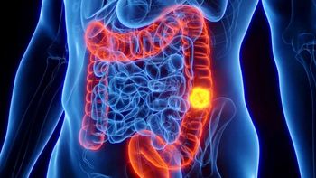 Este síntoma de cáncer de colon también se presenta con otras afecciones, como las hemorroides. Este síntoma de cáncer de colon también se presenta con otras afecciones, como las hemorroides.