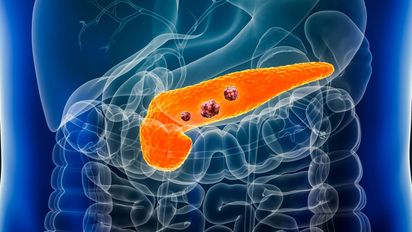 Día Mundial del Cáncer de Páncreas: Datos que preocupan a Argentina y cómo prevenirlo