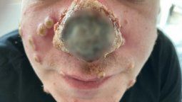 Tejido nasal podrido en paciente con viruela símica.