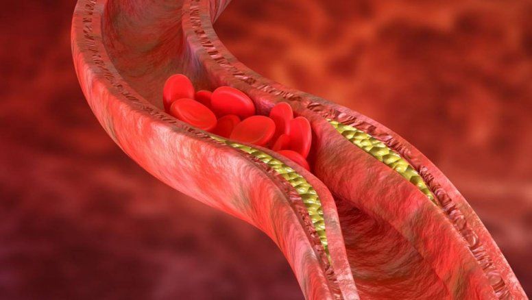 Colesterol alto: Deje de usar este aceite lo antes posible