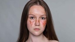 En el Día Mundial del Lupus, una enfermedad autoinmune que afecta a millones, se busca concienciar sobre sus síntomas y promover la búsqueda de una cura. En el Día Mundial del Lupus, una enfermedad autoinmune que afecta a millones, se busca concienciar sobre sus síntomas y promover la búsqueda de una cura.