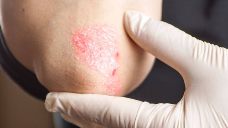 Psoriasis en Argentina: Más del 20% de los pacientes sufre formas severas de la enfermedad