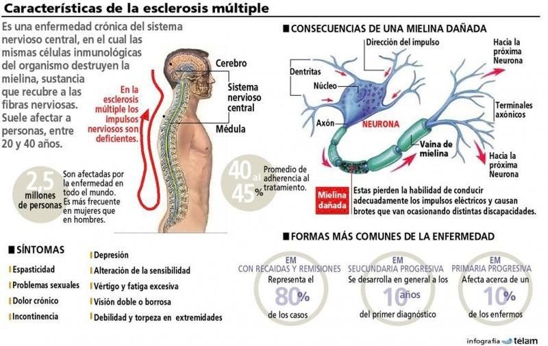 Infografía para una aproximación a la esclerosis múltiple (Telam).