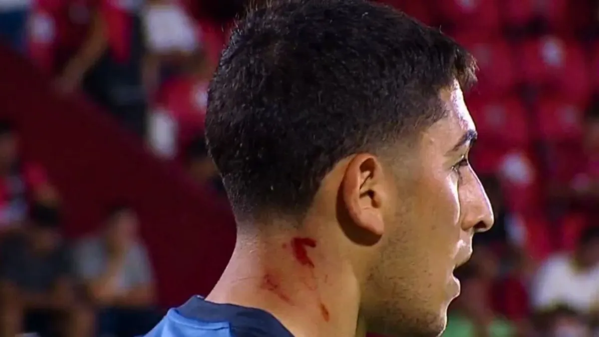 Brey y la sangre en su cuello, durante la entrada en calor de los arqueros Brey y la sangre en su cuello, durante la entrada en calor de los arqueros