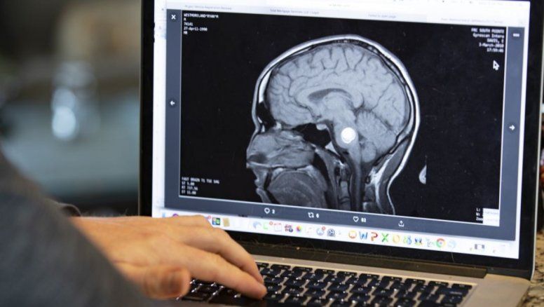 Relacionan la hipertensión con demencia y cerebro pequeño