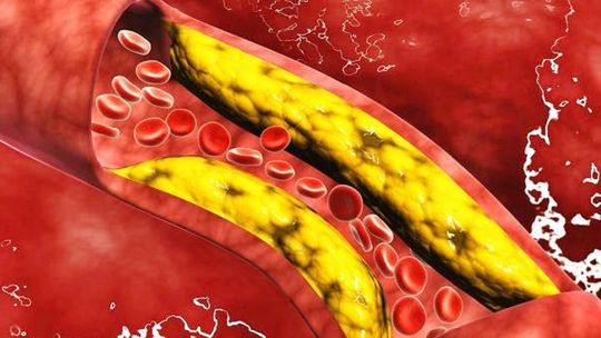 Alimento que aumenta el colesterol: Lo que advierten expertos. Alimento que aumenta el colesterol: Lo que advierten expertos.