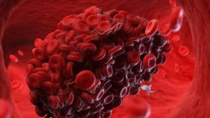 Harvard avisa de coágulos de sangre y algo que muchos hacen
